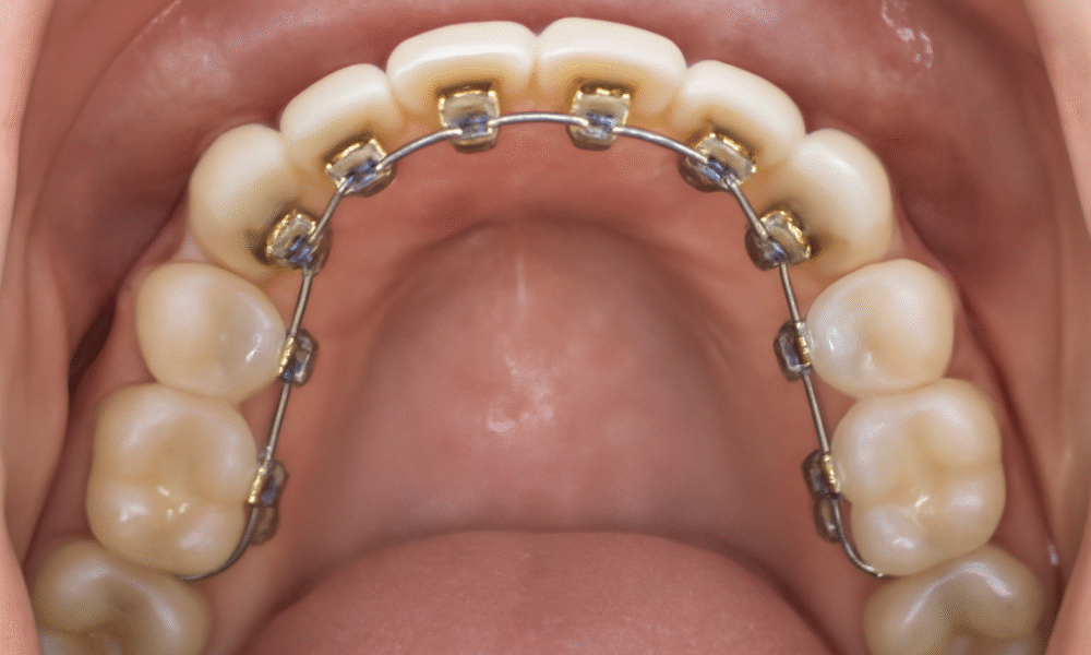 A close-up view of lingual braces attached to the back of upper teeth, showing gold-colored brackets and a smooth, well-maintained set of teeth. The image highlights the inner side of the teeth with clear visibility of the braces, tongue, and gums.