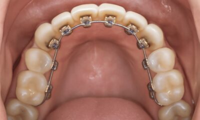 Close-up of gold lingual braces on upper teeth, showing clear visibility of brackets, tongue, gums, and smooth teeth.