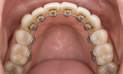 A close-up view of lingual braces attached to the back of upper teeth, showing gold-colored brackets and a smooth, well-maintained set of teeth. The image highlights the inner side of the teeth with clear visibility of the braces, tongue, and gums.