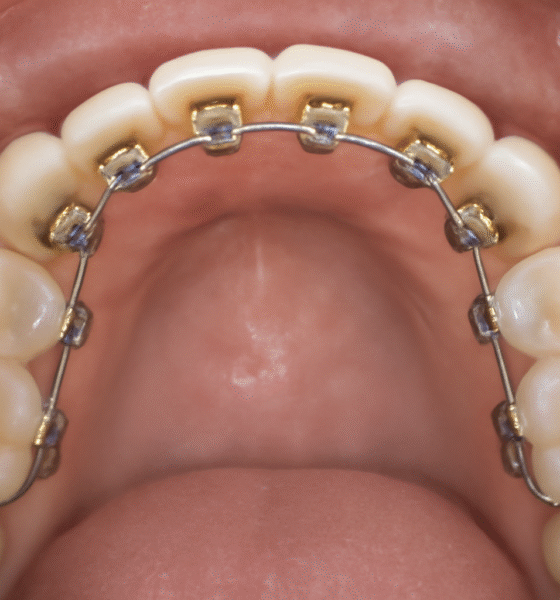 A close-up view of lingual braces attached to the back of upper teeth, showing gold-colored brackets and a smooth, well-maintained set of teeth. The image highlights the inner side of the teeth with clear visibility of the braces, tongue, and gums.