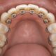 Close-up of gold lingual braces on upper teeth, showing clear visibility of brackets, tongue, gums, and smooth teeth.