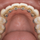 A close-up view of lingual braces attached to the back of upper teeth, showing gold-colored brackets and a smooth, well-maintained set of teeth. The image highlights the inner side of the teeth with clear visibility of the braces, tongue, and gums.