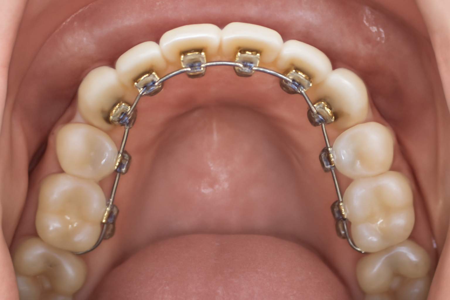 A close-up view of lingual braces attached to the back of upper teeth, showing gold-colored brackets and a smooth, well-maintained set of teeth. The image highlights the inner side of the teeth with clear visibility of the braces, tongue, and gums.
