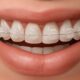 Close-up of a smile showcasing clear ceramic braces with a metal wire, highlighting teeth alignment.