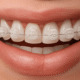 Close-up of a smile showcasing clear ceramic braces with a metal wire, highlighting teeth alignment.