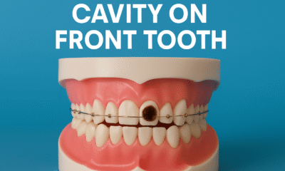 Cavity on front tooth shown in a close-up image, highlighting dental decay for educational and oral health awareness.