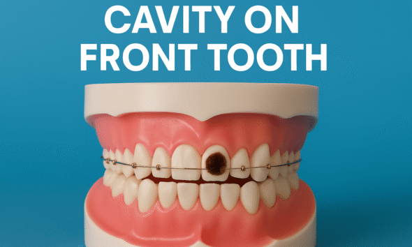 Cavity on front tooth shown in a close-up image, highlighting dental decay for educational and oral health awareness.