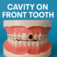 Cavity on front tooth shown in a close-up image, highlighting dental decay for educational and oral health awareness.