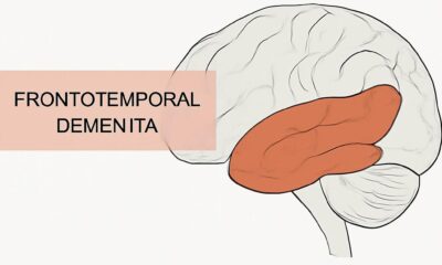 A side view of the brain highlighting the frontal and temporal lobes, labeled for Frontotemporal Dementia.