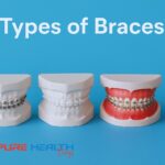 Infographic showing four types of braces: metal braces, ceramic braces, lingual braces, and clear aligners with labels.