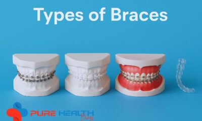 Infographic showing four types of braces: metal braces, ceramic braces, lingual braces, and clear aligners with labels.