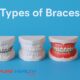 Infographic showing four types of braces: metal braces, ceramic braces, lingual braces, and clear aligners with labels.
