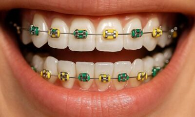 A close-up smile with colorful braces highlighting the cost of lingual braces for adults, showing detailed brackets and wires.
