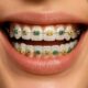 A close-up smile with colorful braces highlighting the cost of lingual braces for adults, showing detailed brackets and wires.