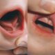 Close-up photo of a lip tie baby showing restricted upper lip movement and oral tissue detail, highlighting lip tie condition.