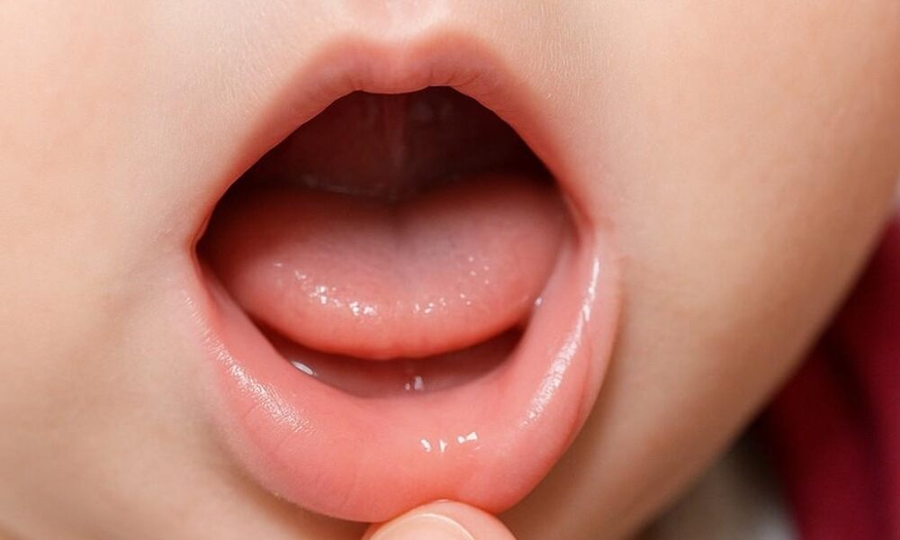 Close-up of a baby's open mouth showing lip tie, with a finger gently pulling the lip to reveal the condition. Focus: lip tie babies.