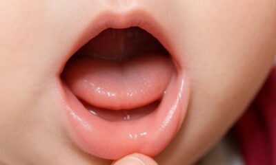 Close-up of a baby's open mouth showing lip tie, with a finger gently pulling the lip to reveal the condition. Focus: lip tie babies.